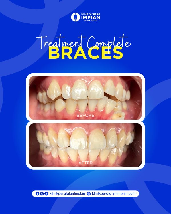braces-1