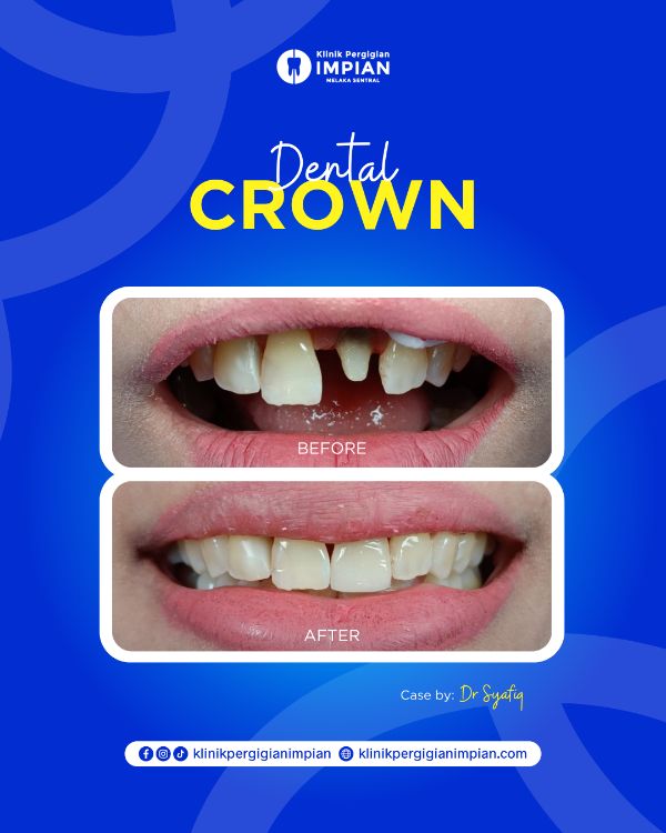 crown-2