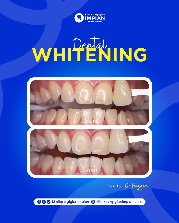 whitening-1